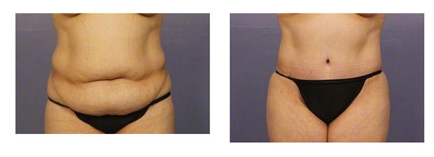 Mini Tummy Tuck Before And After Photos