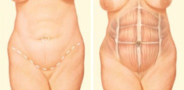 Tummy Tuck Austin Procedures