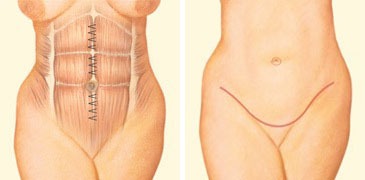Tummy Tuck Austin Procedures