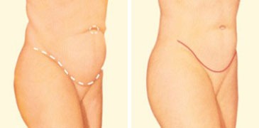 Tummy Tuck Austin Procedures